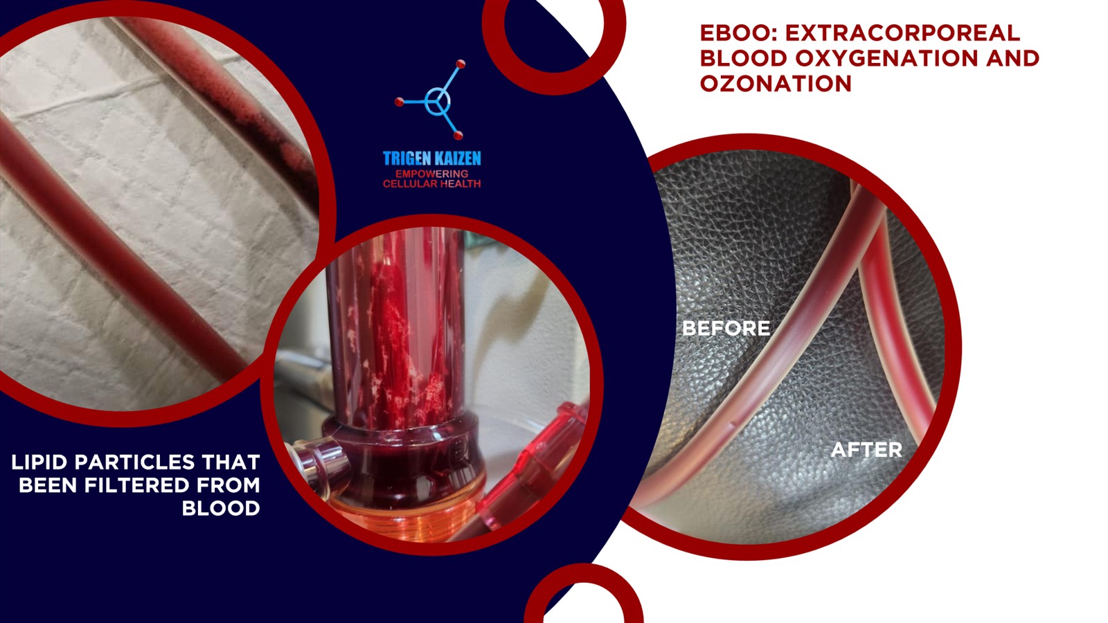 EBOO extracorporeal blood oxygenation and ozonation — before and after