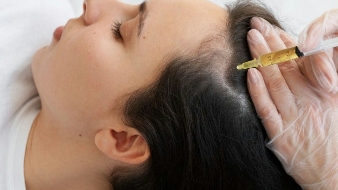 Hair Restoration: PRF + Peptide